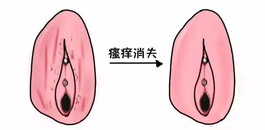 外阴白斑好转的迹象有哪些？