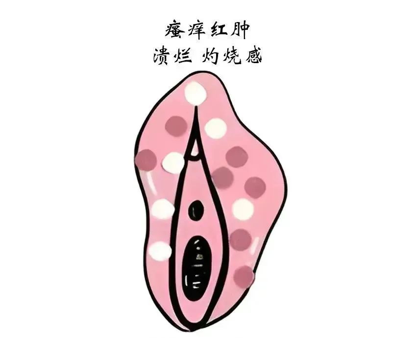 各个类型的外阴白斑具体分期和主要症状有哪些？
